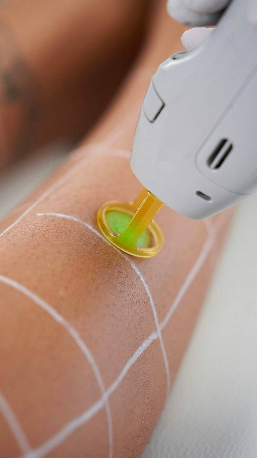 Close-up view of a laser hair removal device being used on a person's leg with grid markings on the skin to ensure precision.